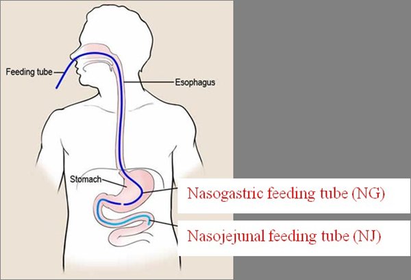 Types of enteral feeding