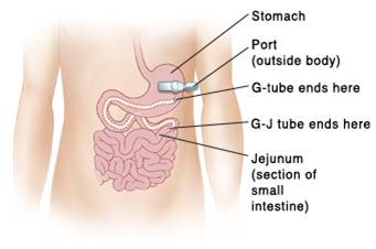 Jejunostomy Feeding