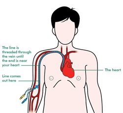 Parenteral Nutrition via PICC Line