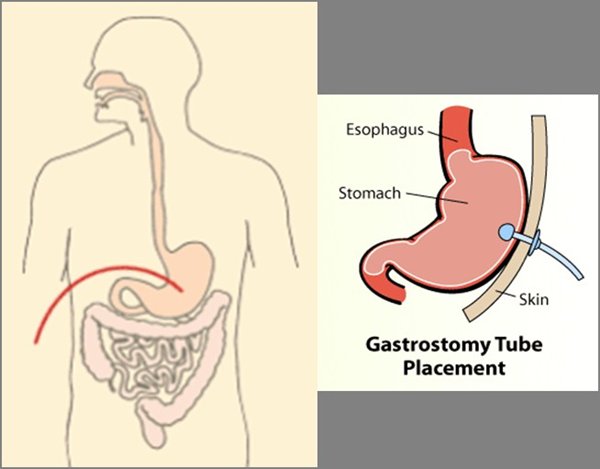 Gastrostomy Feeding