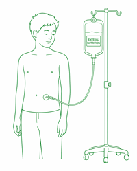 boy-with-enteral-feeding-tube.png