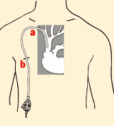 Parenteral Nutrition Diagram